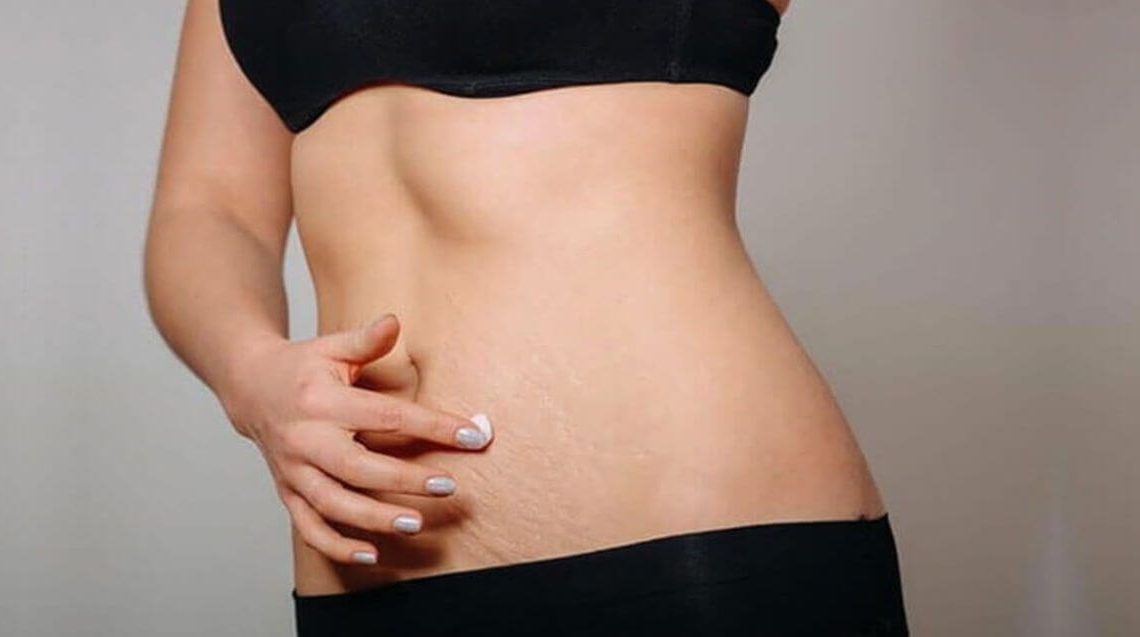 get-rid-of-stretch-marks