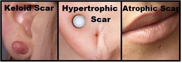 types-of-scars