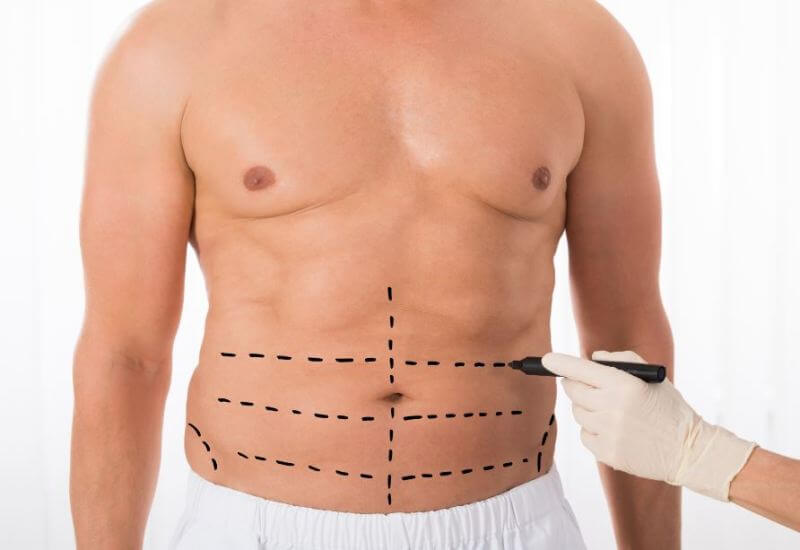 liposuction-plastic-surgery