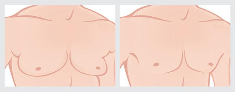 male-breast-reduction-surgery