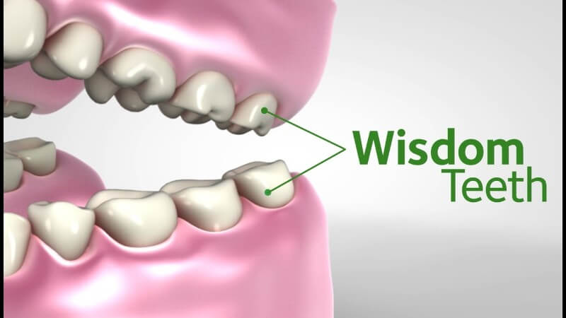 symptoms of wisdom teeth