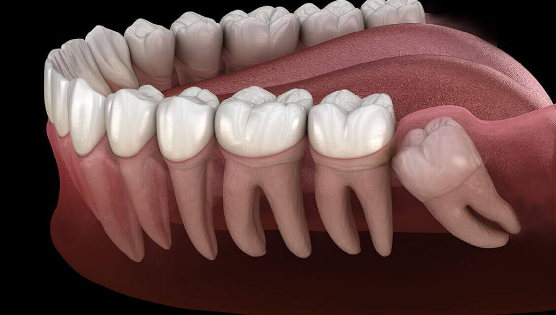 wisdom teeth treatment