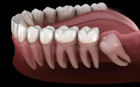 wisdom teeth treatment