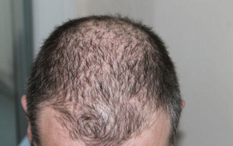 the hair transplantation cost