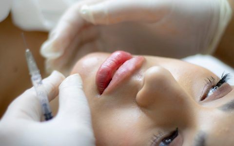 Lip Filler Swelling Stages